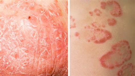 Psoriasis en oogziekten